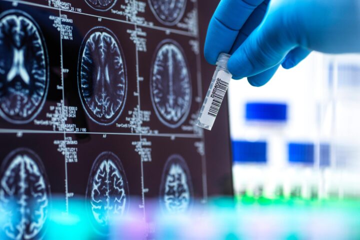 EU-Kommission lässt neues Alzheimer-Medikament zu