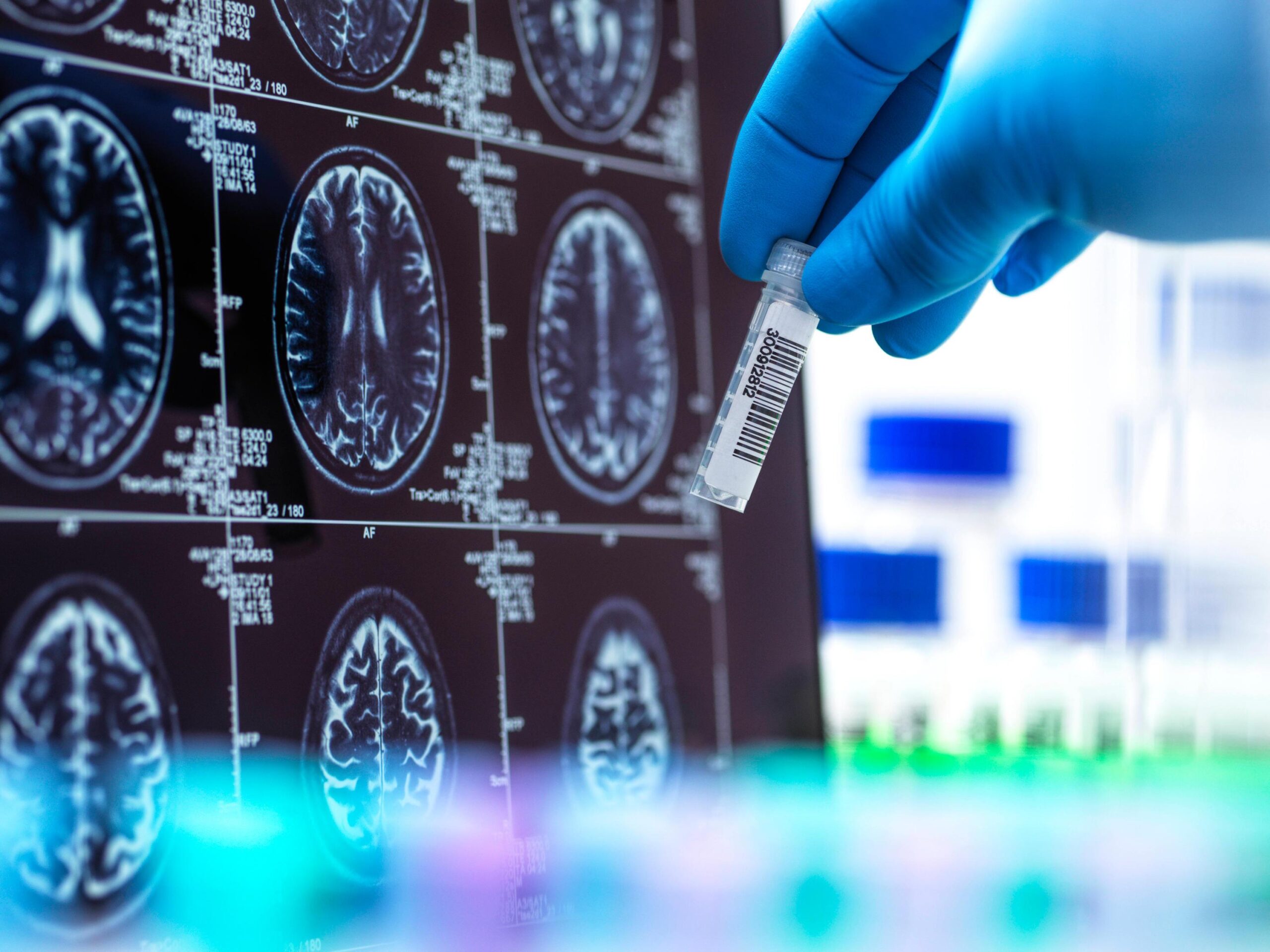 EU-Kommission lässt neues Alzheimer-Medikament zu